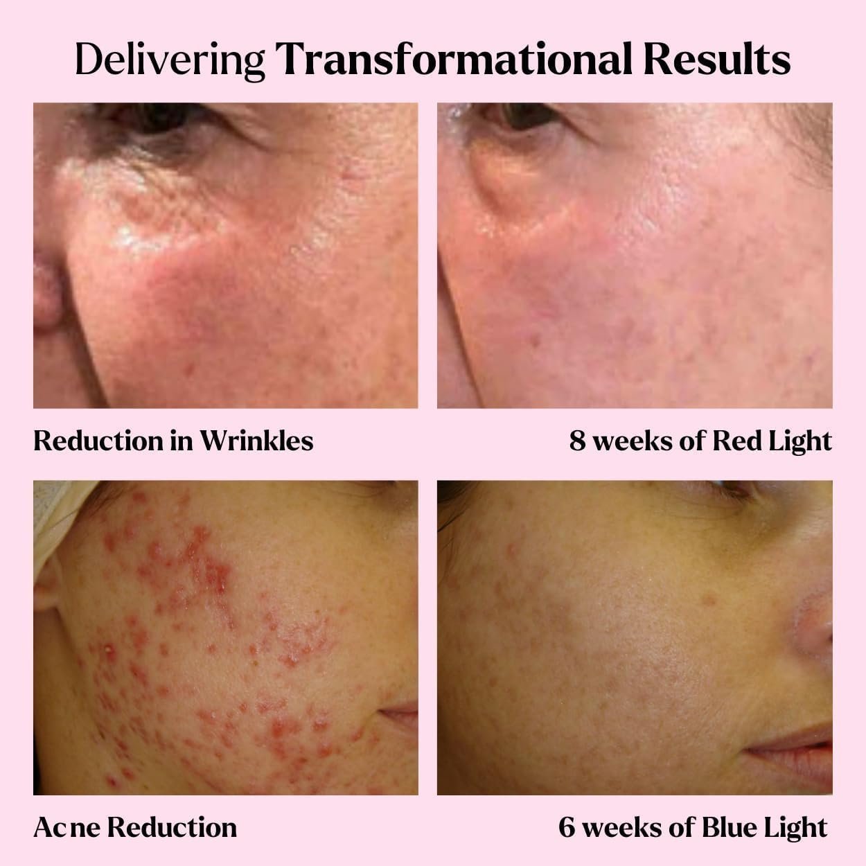 LED Face Mask Light Therapy Premium Spa Kit (4 Pcs) - With Ultrasonic Scrubber, Sonic Brush & Green Tea Serum - Image 3