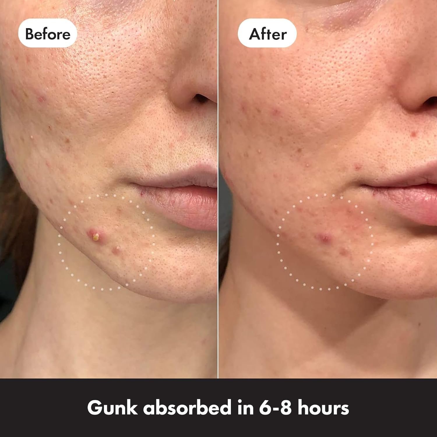 Mighty Patch Original Spot Patches by Hero Cosmetics, Day & Night Time Acne Treatment - Spot Treatment Pimple Stickers - 36 Patches - Image 4